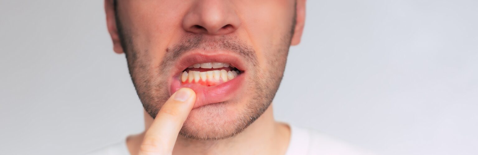 gum recession dallas