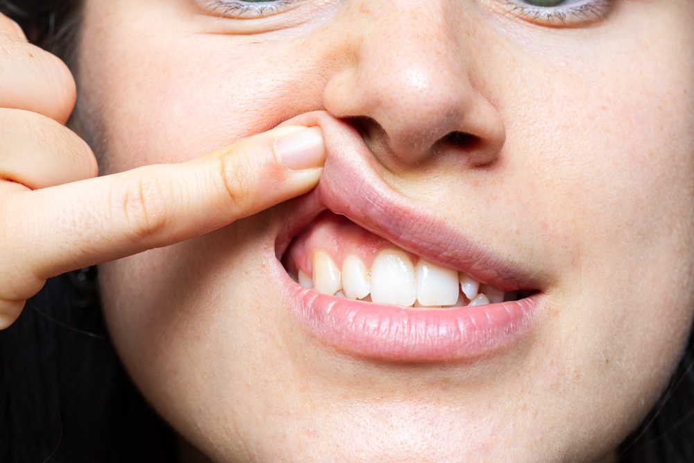 swollen gums after flossing